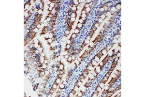 Anti-FER antibody, IHC(P) IHC(P): Human Intestinal Cancer Tissue