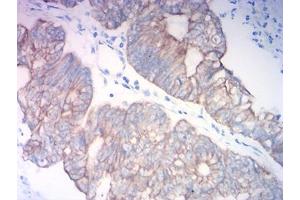 Immunohistochemical analysis of paraffin-embedded colon cancer tissues using KRT18 mouse mAb with DAB staining. (Cytokeratin 18 anticorps  (AA 1-150))