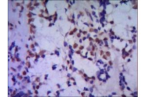 IHC of paraffin-embedded huma breast cancer using anti-TBLR1 mouse mAb diluted 1/500-1/1000 (TBL1XR1 anticorps)