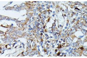 Immunohistochemistry of paraffin-embedded Human lung cancer using MAP3K3 Polyclonal Antibody at dilution of 1:100 (40x lens). (MAP3K3 anticorps)