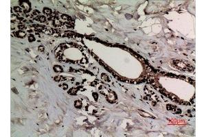 Immunohistochemistry (IHC) analysis of paraffin-embedded Human Breast Cancer, antibody was diluted at 1:100.