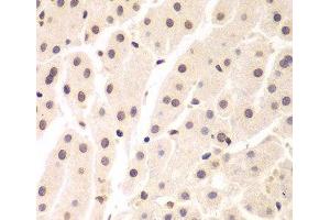 Immunohistochemistry of paraffin-embedded Human liver cancer using UHRF2 Polyclonal Antibody at dilution of 1:200 (40x lens). (UHRF2 anticorps)