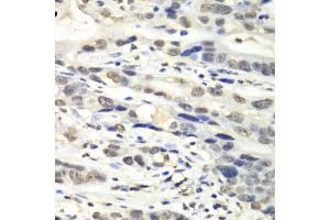 Immunohistochemistry of paraffin-embedded human gastric cancer using NUDT1 antibody (ABIN6292587) at dilution of 1:100 (40x lens). (NUDT1 anticorps)