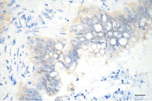 Immunohistochemistry was performed on paraffin-embedded human pancreatic adenocarcinoma using SBDS antibody (ABIN7800330), 1:200).