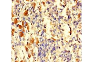 Immunohistochemistry of paraffin-embedded human melanoma using ABIN7166593 at dilution of 1:100 (TGFA anticorps  (AA 40-89))
