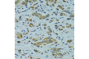 Immunohistochemistry of paraffin-embedded human gastric cancer using STX1A antibody (ABIN1876774) at dilution of 1:100 (40x lens). (STX1A anticorps)