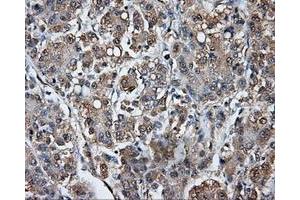 Immunohistochemical staining of paraffin-embedded Carcinoma of liver tissue using anti-TPMT mouse monoclonal antibody. (TPMT anticorps)