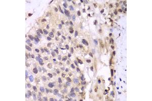 Immunohistochemistry of paraffin-embedded human lung cancer using PSMA6 antibody at dilution of 1:100 (400x lens). (PSMA6 anticorps)