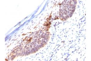 Formalin-fixed, paraffin-embedded human Skin stained with CD1a Monoclonal Antibody (SPM120). (CD1a anticorps)