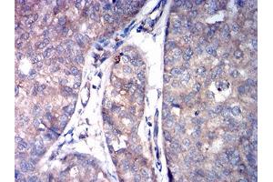Immunohistochemical analysis of paraffin-embedded bladder cancer tissues using ASGR2 mouse mAb with DAB staining.