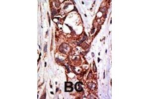 Formalin-fixed and paraffin-embedded human cancer tissue reacted with the primary antibody, which was peroxidase-conjugated to the secondary antibody, followed by DAB staining.