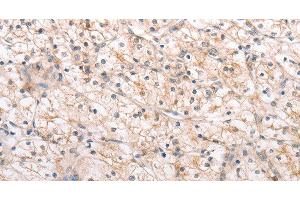 Immunohistochemistry of paraffin-embedded Human renal cancer using MMP11 Polyclonal Antibody at dilution of 1:40 (MMP11 anticorps)
