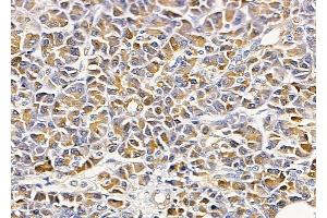 ABIN6265117 and ABIN6279851 at 1/100 staining Human gastric cancer by IHC-P.