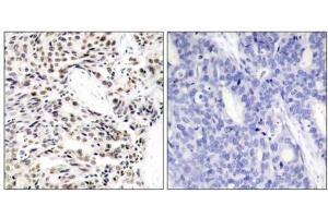 Immunohistochemical analysis of paraffin-embedded human breast carcinoma tissue using NF-κB p65 (Ab-529) antibody (E021210). (NF-kB p65 anticorps)