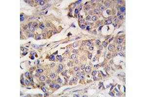 IHC analysis of FFPE human breast carcinoma tissue stained with ACO2 antibody
