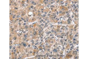 Immunohistochemistry of Human thyroid cancer using CHMP4B Polyclonal Antibody at dilution of 1:40