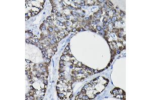 Immunohistochemistry of paraffin-embedded human liver cancer using GSTK1 Rabbit pAb (ABIN1680136, ABIN3019398, ABIN3019399 and ABIN6220875) at dilution of 1:25 (40x lens).