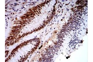 Immunohistochemical analysis of paraffin-embedded colon cancer tissues using KDM1A mouse mAb with DAB staining.