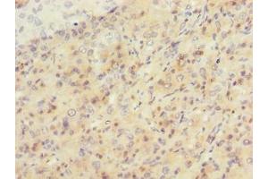 Immunohistochemistry of paraffin-embedded human liver cancer using ABIN7169695 at dilution of 1:100 (SIPA1L2 anticorps  (AA 522-778))