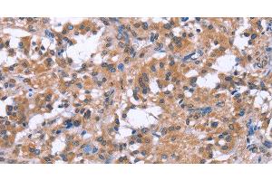 Immunohistochemistry of paraffin-embedded Human thyroid cancer tissue using GPR172B Polyclonal Antibody at dilution 1:40