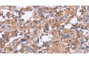 Immunohistochemistry of paraffin-embedded Human thyroid cancer tissue using GPR172B Polyclonal Antibody at dilution 1:40 (GPR172B anticorps)