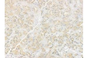 p38 MAPK Antibody at 1/100 staining human renal cell carcinoma by IHC-P. (MAPK14 anticorps  (Internal Region))