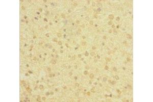 Immunohistochemistry of paraffin-embedded human glioma using ABIN7143220 at dilution of 1:100 (Diazepam Binding Inhibitor anticorps  (AA 2-105))