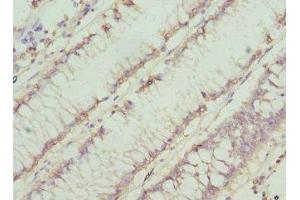 Immunohistochemistry of paraffin-embedded human colon cancer using ABIN7160753 at dilution of 1:100 (CHN1 anticorps  (AA 1-200))
