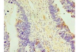 Immunohistochemistry of paraffin-embedded human ovarian cancer using ABIN7150151 at dilution of 1:100 (APOBEC3C anticorps  (AA 1-190))