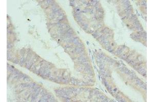 Immunohistochemistry of paraffin-embedded human endometrial cancer using ABIN7156846 at dilution of 1:100 (IL-2 anticorps  (AA 25-176))