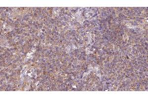 ABIN6273201 at 1/100 staining Human lymph cancer tissue by IHC-P. (ARL6 anticorps  (Internal Region))