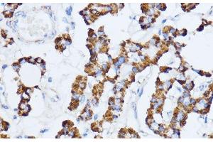 Immunohistochemistry of paraffin-embedded Human thyroid cancer using MAOA Polyclonal Antibody at dilution of 1:100 (40x lens). (Monoamine Oxidase A anticorps)