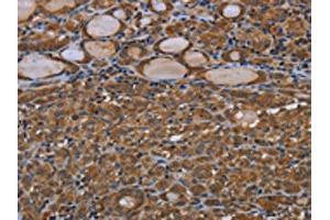 The image on the left is immunohistochemistry of paraffin-embedded Human thyroid cancer tissue using ABIN7190808(GJB4 Antibody) at dilution 1/40, on the right is treated with synthetic peptide. (GJB4 anticorps)