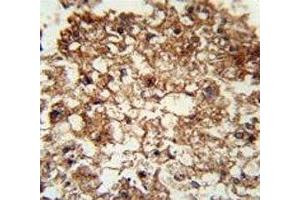 CD11b antibody immunohistochemistry analysis in formalin fixed and paraffin embedded human hepatocarcinoma.