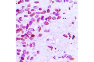 Immunohistochemical analysis of Estrogen Receptor alpha (pS106) staining in human breast cancer formalin fixed paraffin embedded tissue section.