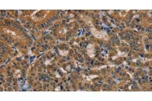 Immunohistochemistry of paraffin-embedded Human thyroid cancer using TAB3 Polyclonal Antibody at dilution of 1:35