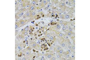 Immunohistochemistry of paraffin-embedded human liver injury using BEST1 antibody (ABIN6003520) at dilution of 1/100 (40x lens). (Bestrophin 1 anticorps)
