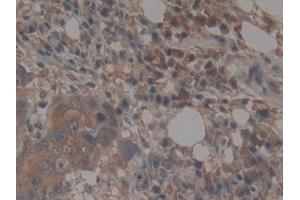 Detection of TEP1 in Human Breast cancer Tissue using Polyclonal Antibody to Telomerase protein component 1 (TEP1)