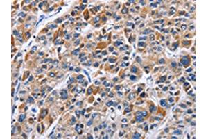 The image on the left is immunohistochemistry of paraffin-embedded Human liver cancer tissue using ABIN7129371(ENPP5 Antibody) at dilution 1/40, on the right is treated with fusion protein. (ENPP5 anticorps)