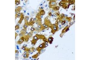 Immunohistochemical analysis of KIF3A staining in human liver cancer formalin fixed paraffin embedded tissue section.