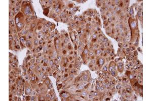 IHC-P Image Immunohistochemical analysis of paraffin-embedded human adrenal gland tumor, using SERTAD1, antibody at 1:100 dilution. (SERTAD1 anticorps  (N-Term))