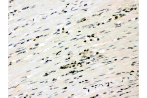 Anti- RUNX3 Picoband antibody, IHC(P): Human Intestinal Cancer Tissue