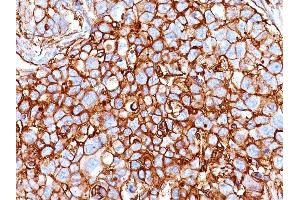 Formalin-fixed, paraffin-embedded human Breast Carcinoma stained with CD44 Mouse Monoclonal Antibody (HCAM/918). (CD44 anticorps)