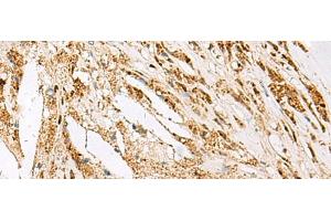 Immunohistochemistry of paraffin-embedded Human thyroid cancer tissue using DNPEP Polyclonal Antibody at dilution of 1:60(x200)