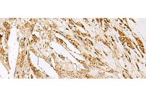 Immunohistochemistry of paraffin-embedded Human thyroid cancer tissue using DNPEP Polyclonal Antibody at dilution of 1:60(x200) (Aspartyl Aminopeptidase anticorps)