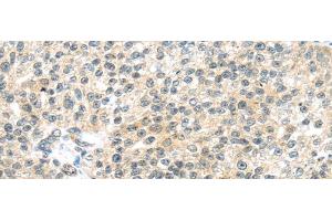Immunohistochemistry of paraffin-embedded Human breast cancer tissue using TTBK2 Polyclonal Antibody at dilution 1:45
