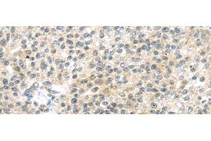 Immunohistochemistry of paraffin-embedded Human breast cancer tissue using TTBK2 Polyclonal Antibody at dilution 1:45 (TTBK2 anticorps)