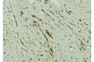 ABIN6273132 at 1/100 staining Human breast cancer tissue by IHC-P. (MAD2L2 anticorps  (Internal Region))