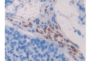 Detection of CD63 in Human Lung cancer Tissue using Polyclonal Antibody to Tetraspanin 30Cluster of Differentiation 63 (CD63)