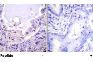 Immunohistochemical analysis of paraffin-embedded human lung carcinoma tissue using RAF1 polyclonal antibody . (RAF1 anticorps)